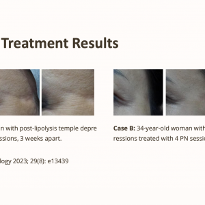 priere eyes PN & Botulinum Peptide
