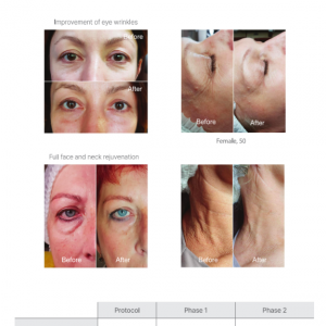Vitaran-I-treatment-effect.png