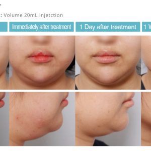 Glamour-slim-before-and-after